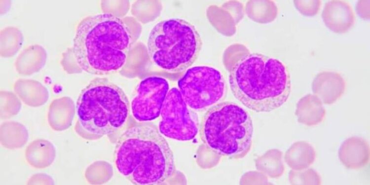 9 de cada 10 pacientes con leucemia linfocítica crónica no reconocen los síntomas antes del diagnóstico